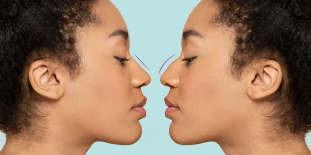 How long does a non surgical nose job last