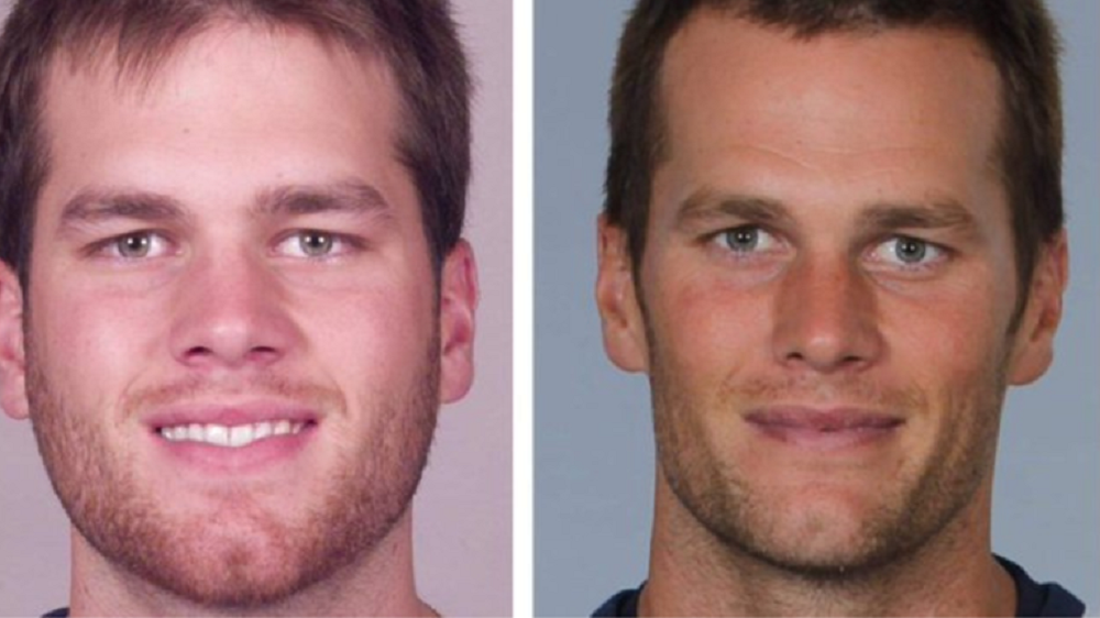 Tom Brady plastic surgery rumors.